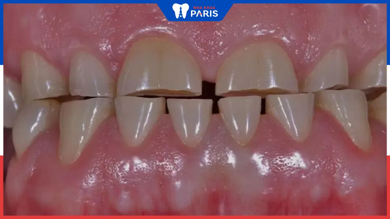 Răng bị mòn mặt nhai do đâu? Cách khắc phục hiệu quả
